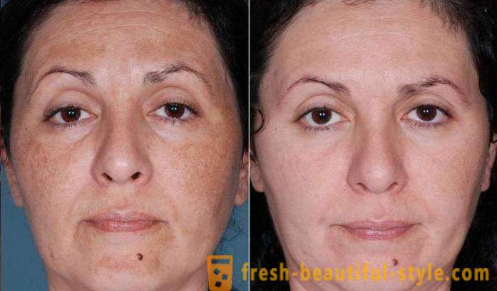Kiselina pilinga za lice: recenzije, fotografije prije i poslije