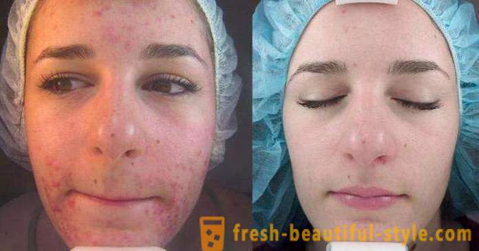 Kiselina pilinga za lice: recenzije, fotografije prije i poslije