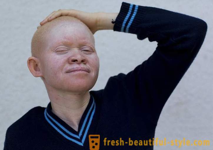 Tragična povijest Tanzanija albino