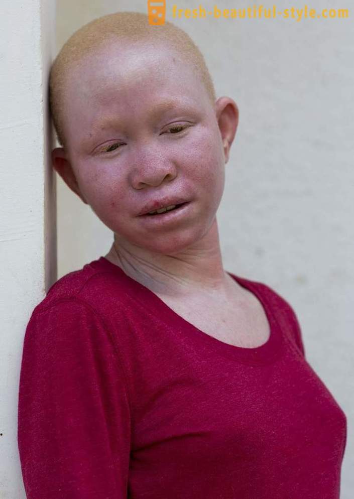 Tragična povijest Tanzanija albino