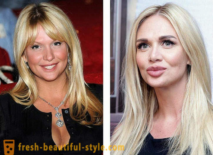 10 Ruski ljepotice prije i nakon plastične
