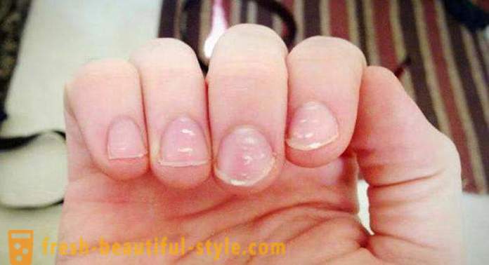 Bijele mrlje na noktima prstiju: uzrocima i liječenju