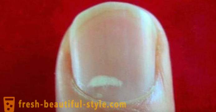 Bijele mrlje na noktima prstiju: uzrocima i liječenju