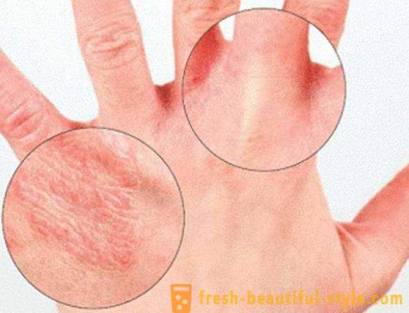 Suha koža ruku: uzroci. Vrlo suha koža, što da radim?