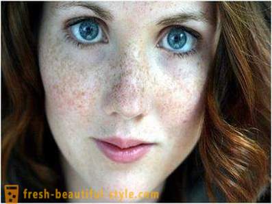 Vodite brigu o svojoj ljepoti i mladosti uzrokuje pigmentaciju na licu
